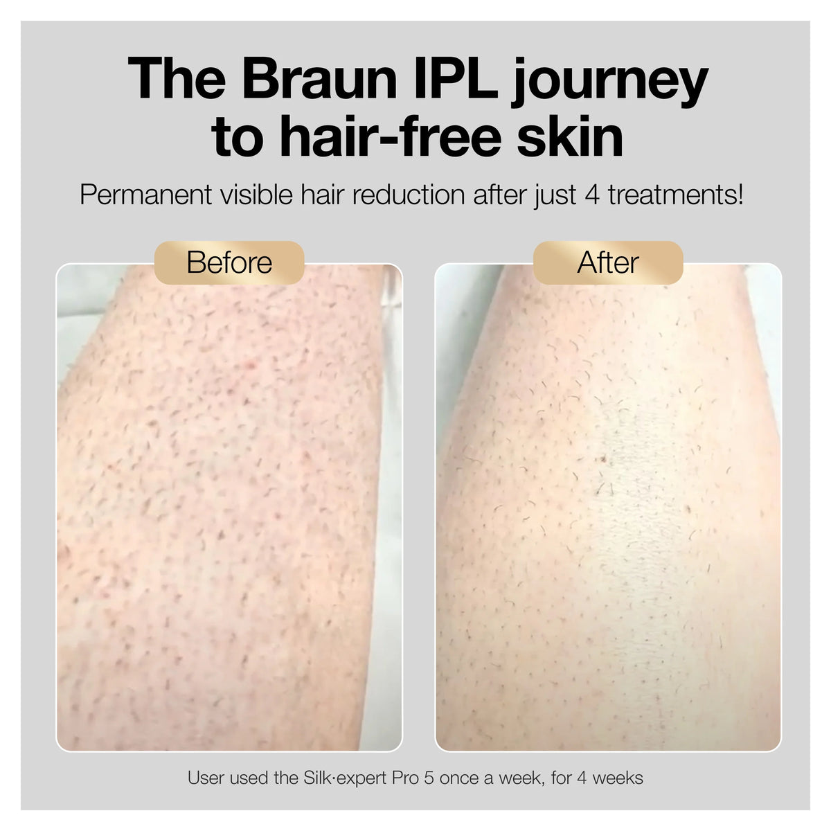 At-Home Hair Removal System S767